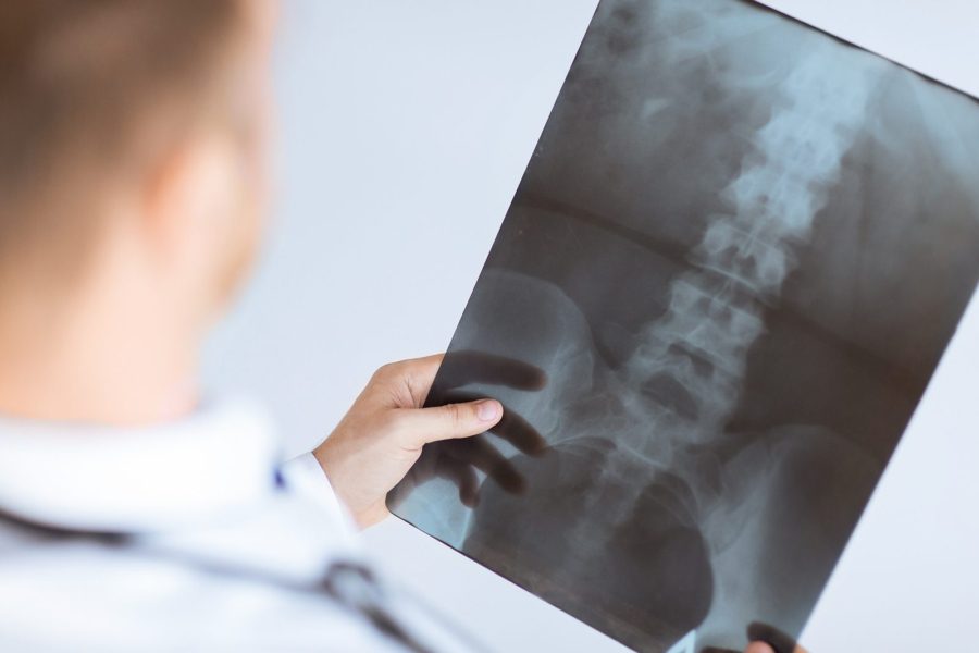 Debunking Common Myths About Spinal Injuries in Personal Injury Claims